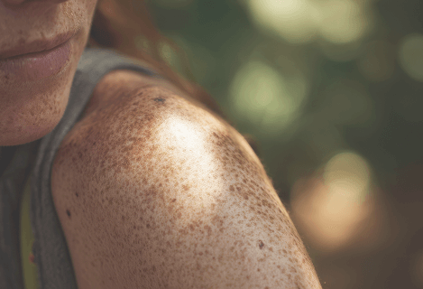 Close-up of a woman's shoulder with freckles bathed in sunlight, symbolizing natural beauty, authenticity, and being comfortable in one's own skin